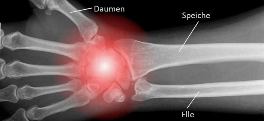 Röntgenbild des Handgelenks mit schematischer Darstellung