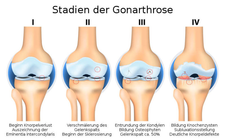 gonarthrose-schmerzfrei-mit-der-richtigen-therapie