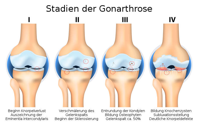 Stadien der Gonarthrose (Kniegelenksarthrose)