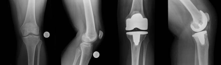 Röntgen des Kniegelenks mit und ohne Prothese