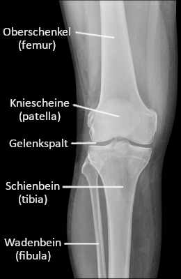 Röntgenaufnahme Knie mit schematischer Darstellung der Anatomie
