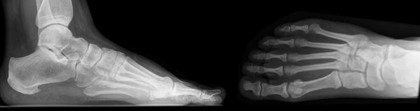 Röntgenbild des Fusses in zwei Ebenen.
