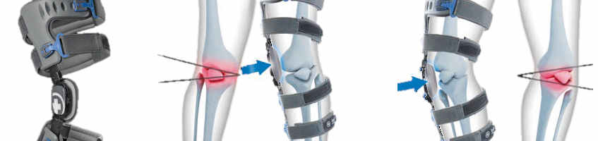 Bort OA-Xpress Knieorthese zur Achskorrektur bei X- und O-Beinen