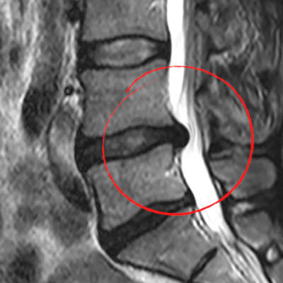 MRI Darstellung eines Bandscheibenvorfalls