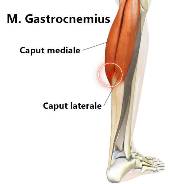 Riss des M. Gastrocnemius mediale