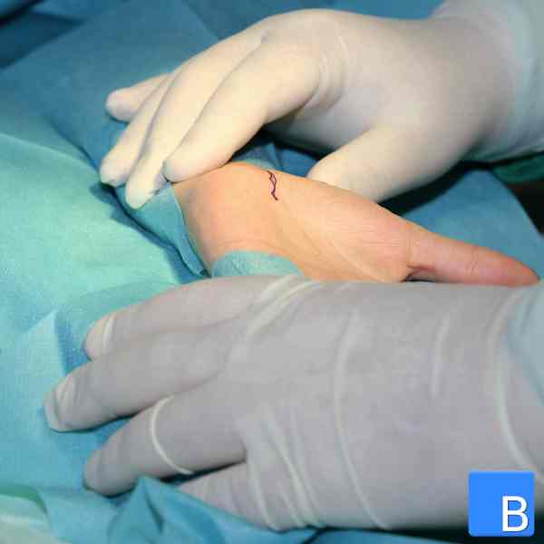 Kartpaltunnel-Syndrom, Operation mit Spaltung des Retinaculum Flexorum