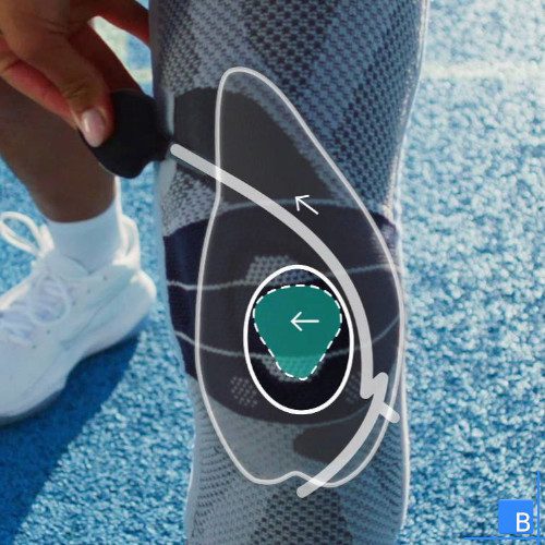 Schematische Darstellung der Patellakorrektur mit Zügel